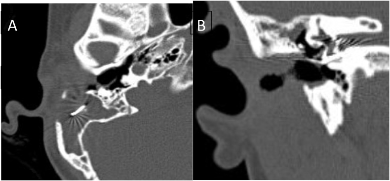 Long-term complications of the transmeatal approach (Open Transcanal) in cochlear implants: A follow-up study