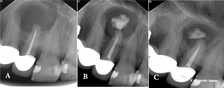 Nonsurgical Endodontic Management of Large Periapical Lesion with Cold Ceramic: A Literature Review and Case Series.