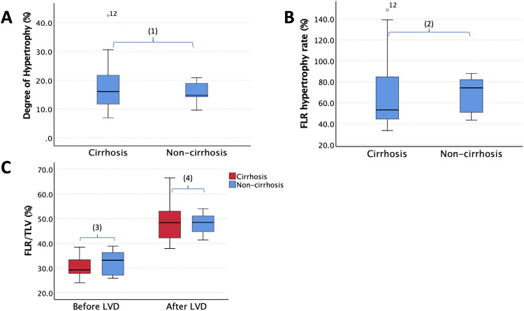 Safety and Efficacy of Liver Venous Deprivation Following Transarterial Chemoembolization Before Major Hepatectomy for Hepatocellular Carcinoma.