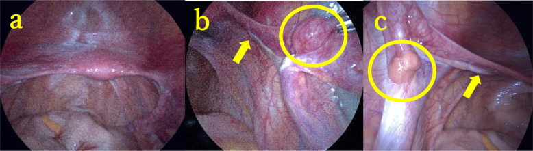 A case of 46,XY complete gonadal dysgenesis with a novel missense variant in <i>SRY</i>.