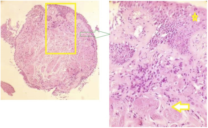 Granular cell tumor of the lung and tracheobronchial tree: Two case-presentation with a review of the literature.