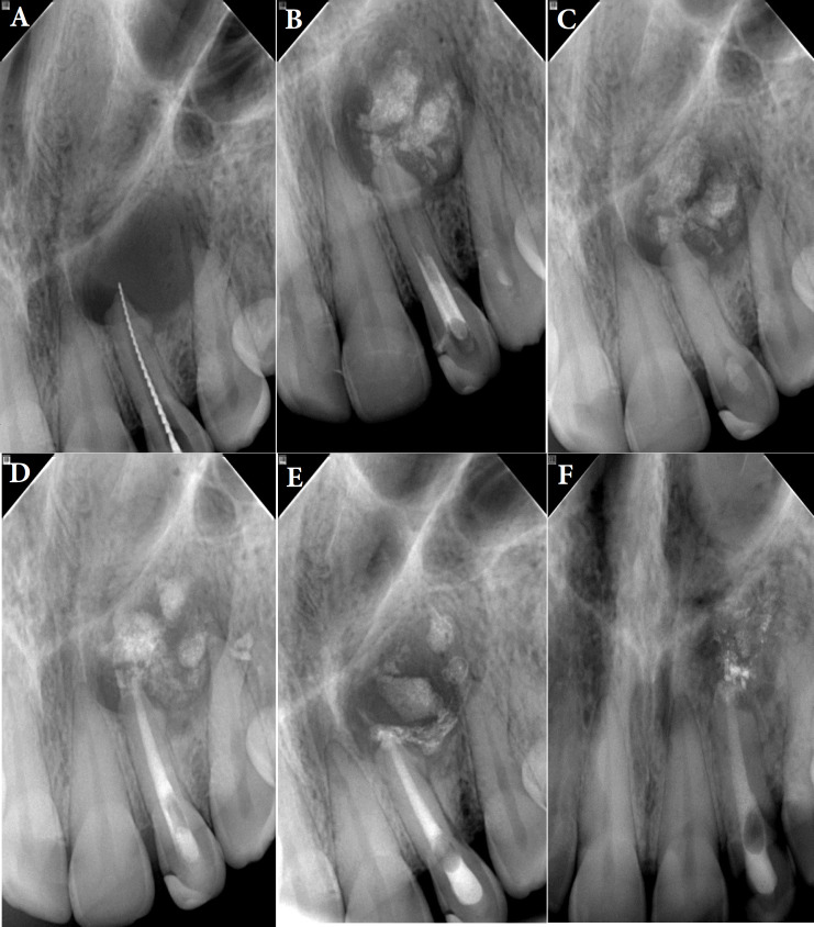 Nonsurgical Endodontic Management of Large Periapical Lesion with Cold Ceramic: A Literature Review and Case Series.