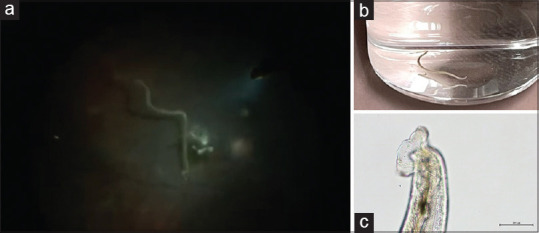 Clinical Course and Optical Coherence Tomography of Ocular Angiostrongyliasis: A Case Report.