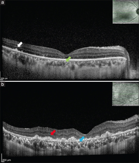 Clinical Course and Optical Coherence Tomography of Ocular Angiostrongyliasis: A Case Report.