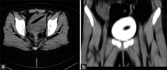 Extraction of foreign body from the urinary bladder using nephroscope: A case report of endoscopy treatment.