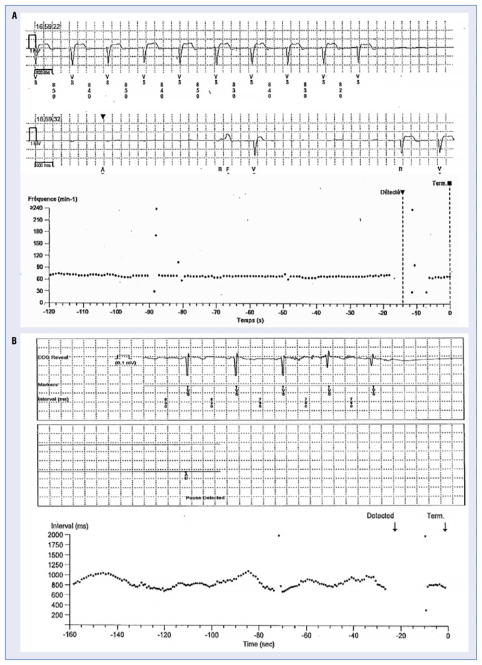 Early and late asystole after loop recorder implantation: Misdiagnoses and unexpected diagnostic opportunities.