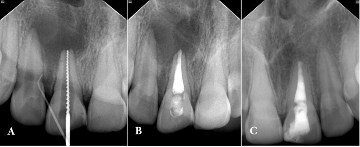 Nonsurgical Endodontic Management of Large Periapical Lesion with Cold Ceramic: A Literature Review and Case Series.