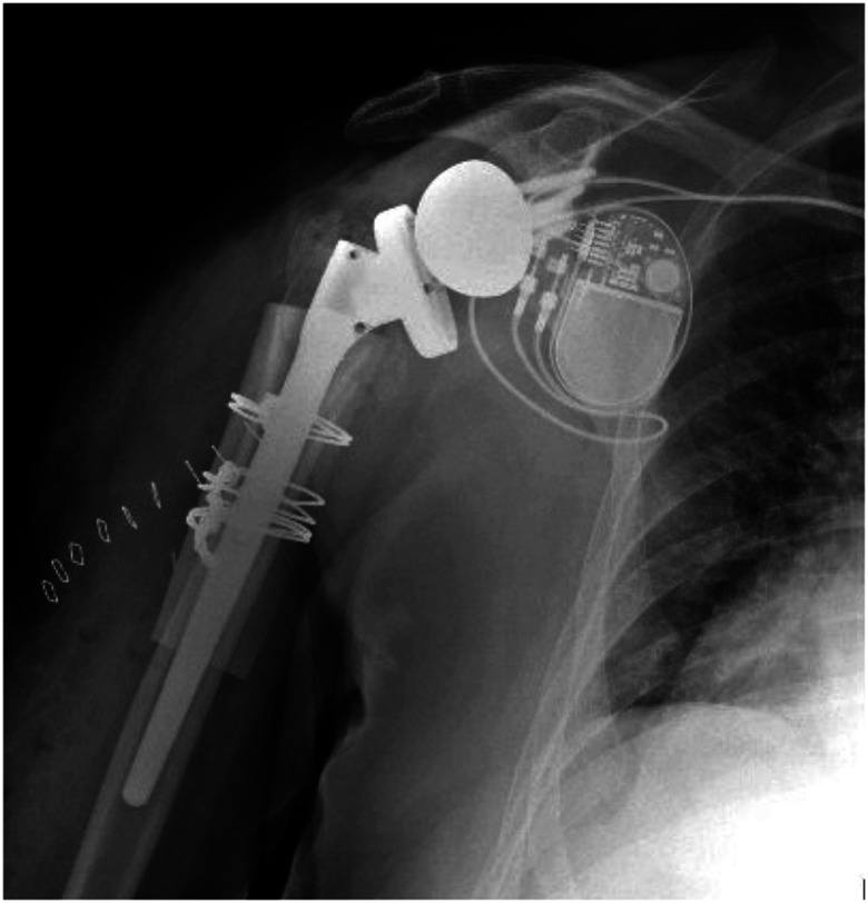 Arthroplasty as Primary Treatment for Metadiaphyseal Proximal Humerus Fractures: A Viable Alternative to Osteosynthesis for the Elderly.