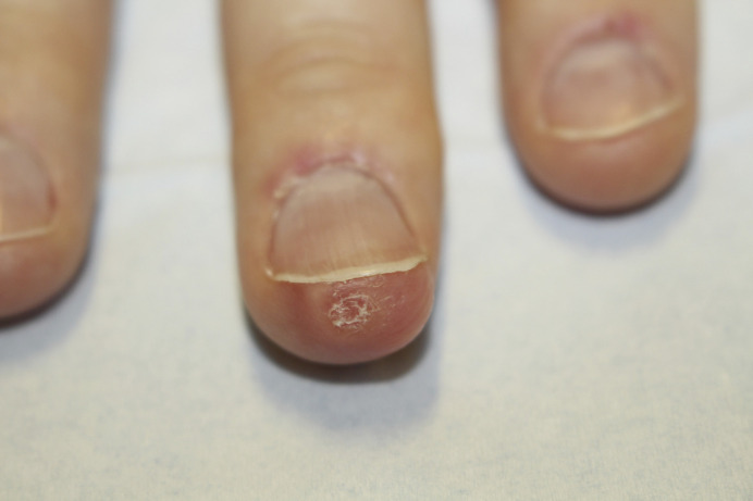 Acral Fibrochondromyxoid Tumor Presenting as Enlarging Nodule Involving the Distal Fingertip and Hyponychium: A Case Report.