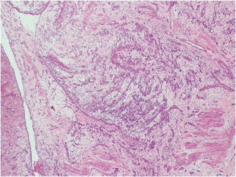 A Case of Rapidly Growing Cardiac Myxoma Within a Year Causing Heart Failure.