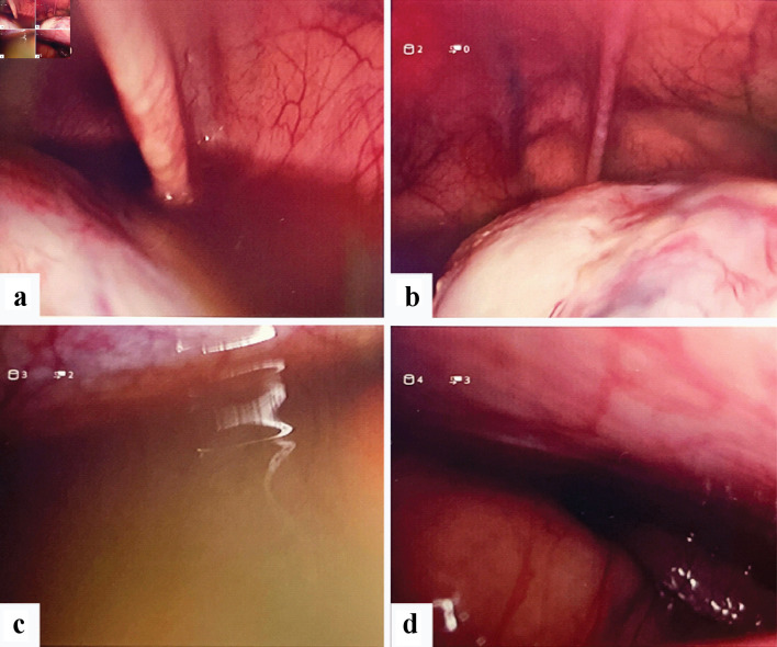 A Presentation of Synchronous Ovarian and Endometrial Endometrioid Adenocarcinoma From a Case of Suspected Ruptured Ectopic Pregnancy.