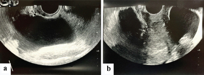 A Presentation of Synchronous Ovarian and Endometrial Endometrioid Adenocarcinoma From a Case of Suspected Ruptured Ectopic Pregnancy.