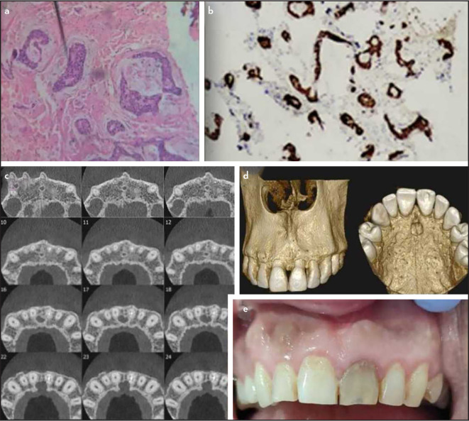 Maxillary Mucinous Adenocarcinoma Mimicking a Lesion of Endodontic Origin: A Rare Case Report.