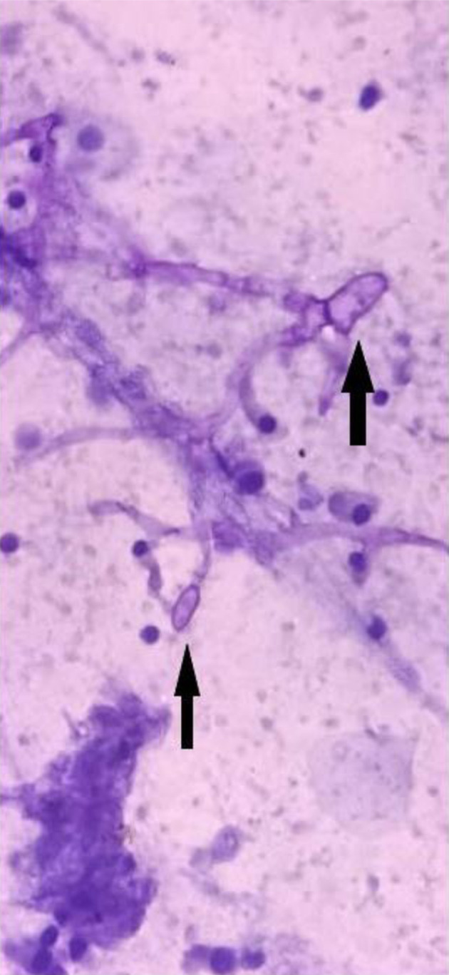 Rapid Cytological Diagnosis With Evaluation of Pre- and Post-Therapeutic Fungal Morphological Characteristics in Mucormycosis.