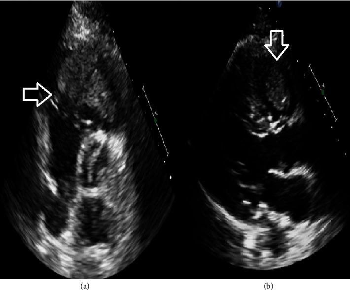 Pathological Correlation of a Cardiac Mass with Multimodality Imaging.