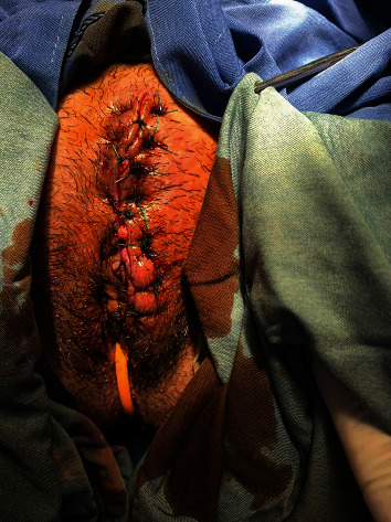 External Genitalia Myiasis in a 40-Year-Old Woman.