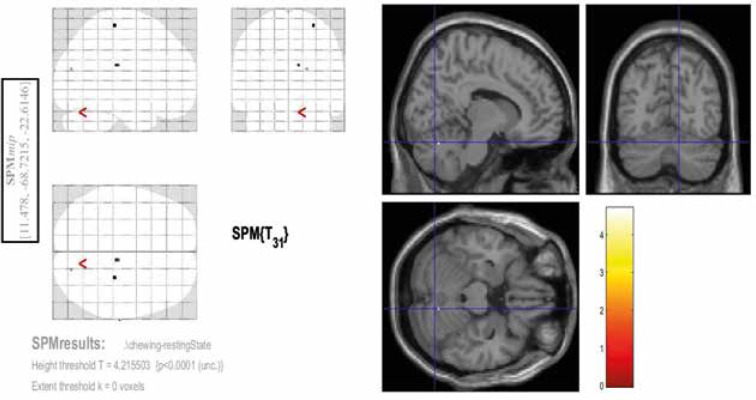 Demonstration of chewing-related areas in the brain via functional magnetic resonance imaging.