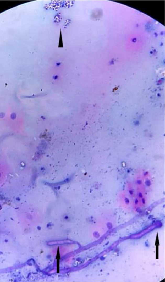 Rapid Cytological Diagnosis With Evaluation of Pre- and Post-Therapeutic Fungal Morphological Characteristics in Mucormycosis.