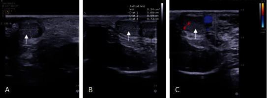 Diagnosis and Management of Polyorchidism: A Case Report and Literature Review.