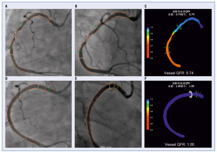 The efficacy and safety of quantitative flow ratio-guided complete revascularization in patients with ST-segment elevation myocardial infarction and multivessel disease: A pilot randomized controlled trial.