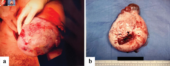 A Presentation of Synchronous Ovarian and Endometrial Endometrioid Adenocarcinoma From a Case of Suspected Ruptured Ectopic Pregnancy.