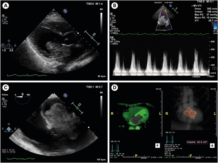 A Case of Rapidly Growing Cardiac Myxoma Within a Year Causing Heart Failure.