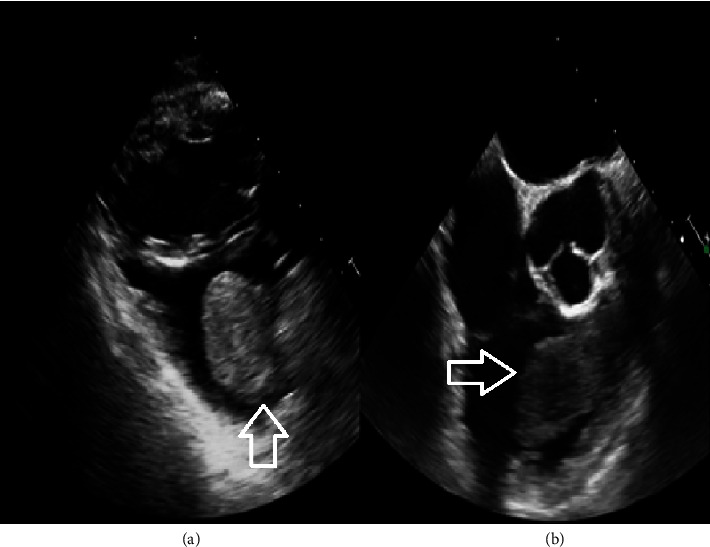 Pathological Correlation of a Cardiac Mass with Multimodality Imaging.