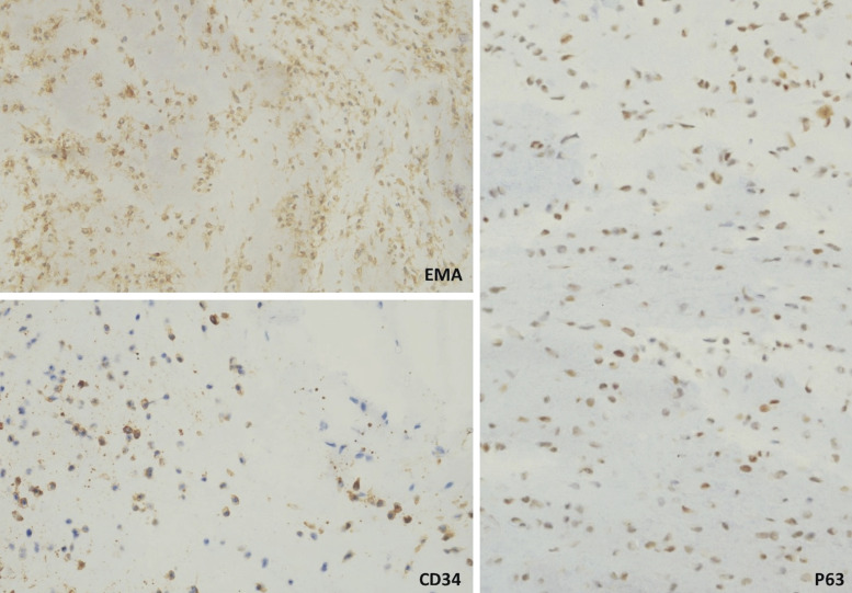 Acral Fibrochondromyxoid Tumor Presenting as Enlarging Nodule Involving the Distal Fingertip and Hyponychium: A Case Report.