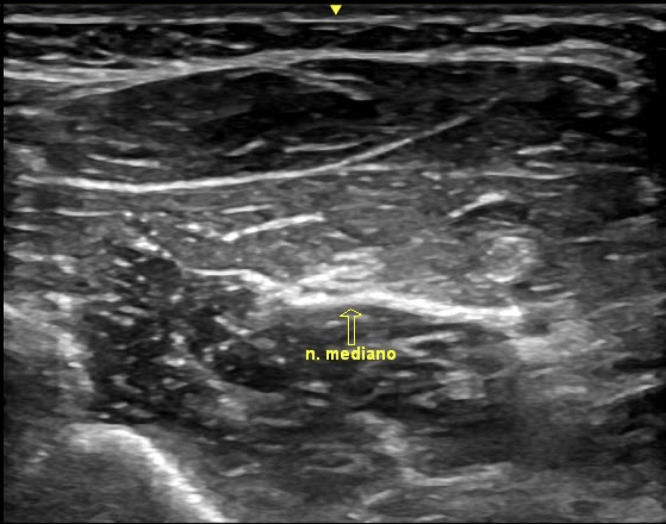 Ultrasound-Guided Percutaneous Neuromodulation in Multiple Sclerosis: A Case Report.