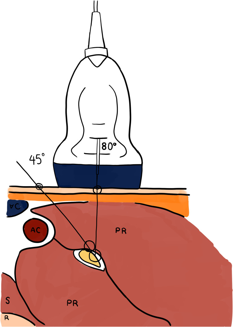 Ultrasound-Guided Percutaneous Neuromodulation in Multiple Sclerosis: A Case Report.