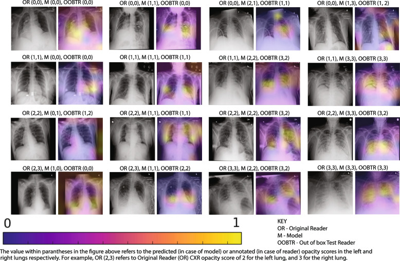 A radiographic, deep transfer learning framework, adapted to estimate lung opacities from chest x-rays.