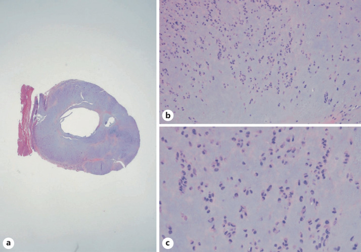 Acral Fibrochondromyxoid Tumor Presenting as Enlarging Nodule Involving the Distal Fingertip and Hyponychium: A Case Report.