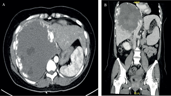 Giant Sclerosing Hepatic Hemangioma Presenting as Bornman-Terblanche-Blumgart Syndrome: a Case Report and Review of the Literature.