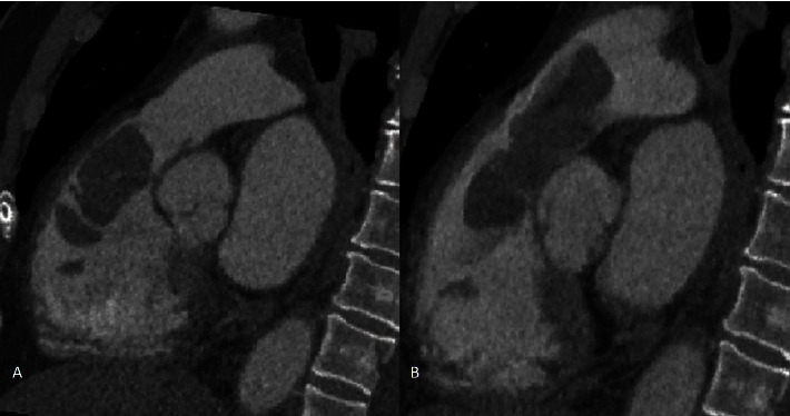 Pathological Correlation of a Cardiac Mass with Multimodality Imaging.