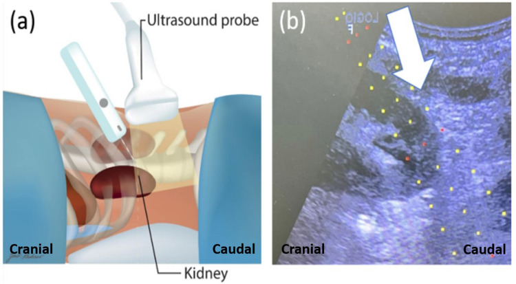 Cranial versus Caudal Direction Technique of Native Percutaneous Kidney Biopsy: A Randomized Controlled Trial.