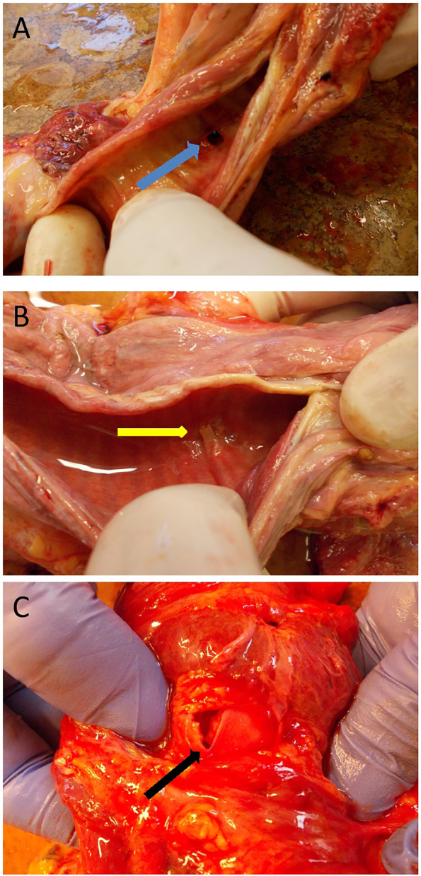 Percutaneous tracheostomy: Comparison of three different methods with respect to tracheal cartilage injury in cadavers-Randomized controlled study.