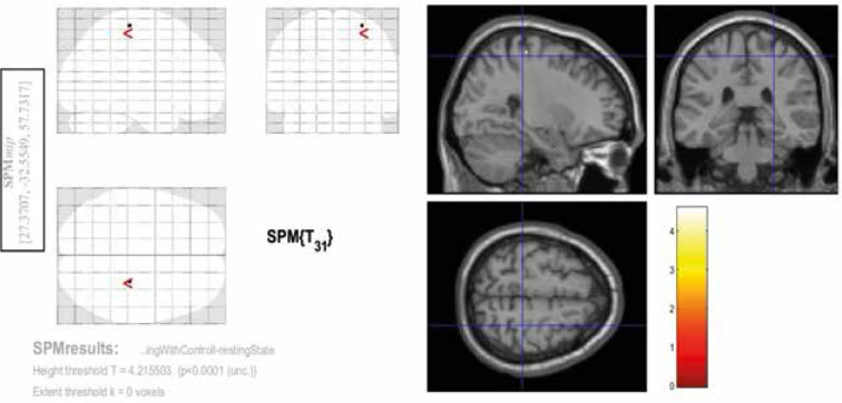 Demonstration of chewing-related areas in the brain via functional magnetic resonance imaging.