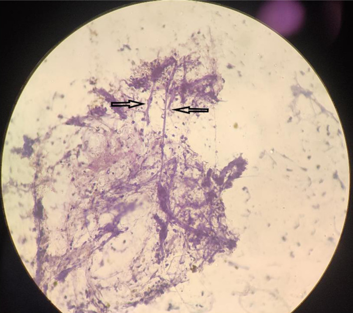 Rapid Cytological Diagnosis With Evaluation of Pre- and Post-Therapeutic Fungal Morphological Characteristics in Mucormycosis.