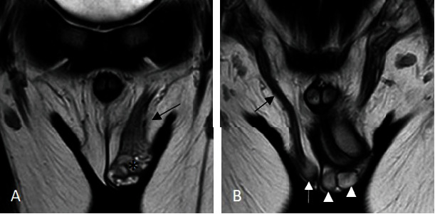 Diagnosis and Management of Polyorchidism: A Case Report and Literature Review.