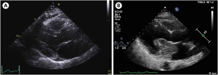 A Case of Rapidly Growing Cardiac Myxoma Within a Year Causing Heart Failure.