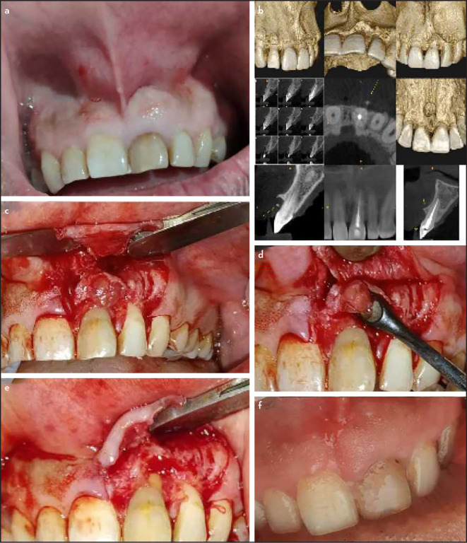 Maxillary Mucinous Adenocarcinoma Mimicking a Lesion of Endodontic Origin: A Rare Case Report.