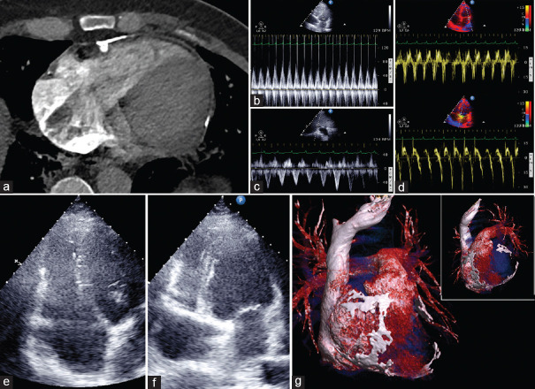 Multi-Modality Imaging Approach to a rare form of Biventricular Ring-Shaped Constrictive Pericarditis.