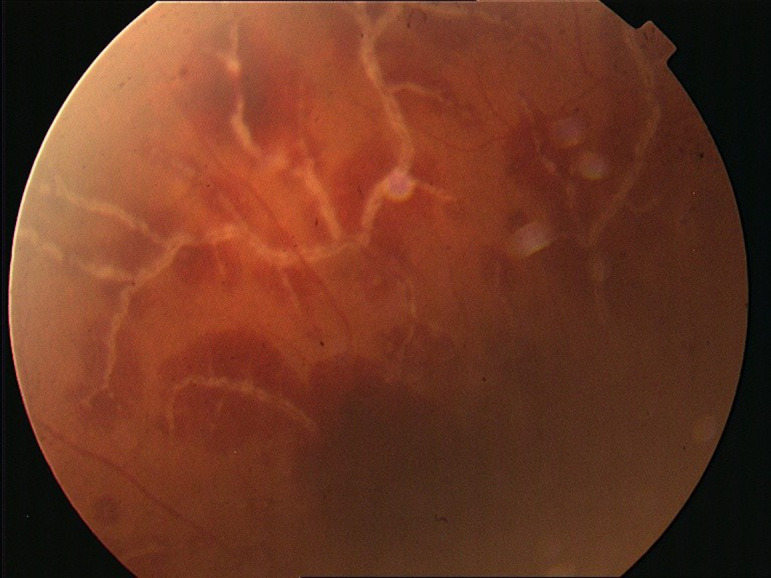 Frosted Branch Angiitis in a Patient with Familial Mediterranean Fever Diagnosis.