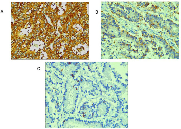 Cystic presentation of primary hepatic neuroendocrine tumour: a case report with a brief review of literature.