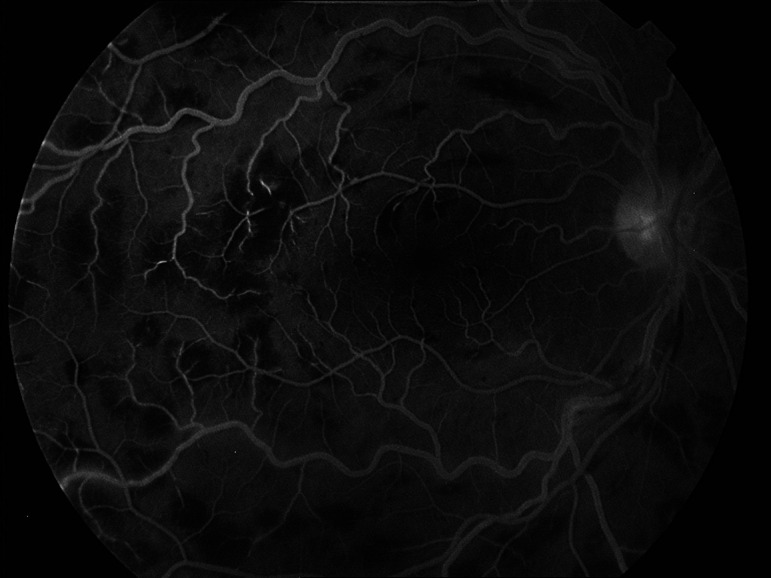 Frosted Branch Angiitis in a Patient with Familial Mediterranean Fever Diagnosis.