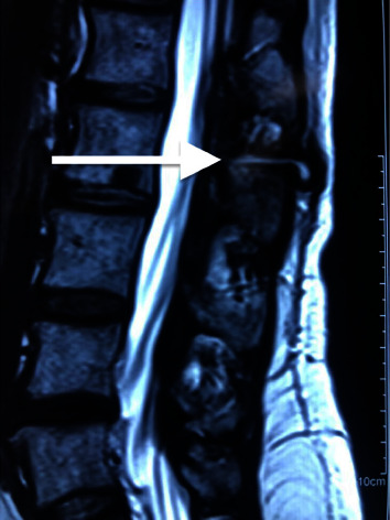 Rare Image of Epidural Catheter Fracture in Lumbar Analgesia.