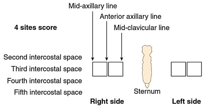 Lung Ultrasound and Caval Indices to Assess Volume Status in Maintenance Hemodialysis Patients.