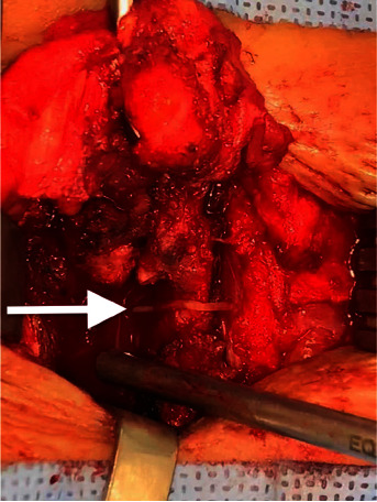 Rare Image of Epidural Catheter Fracture in Lumbar Analgesia.