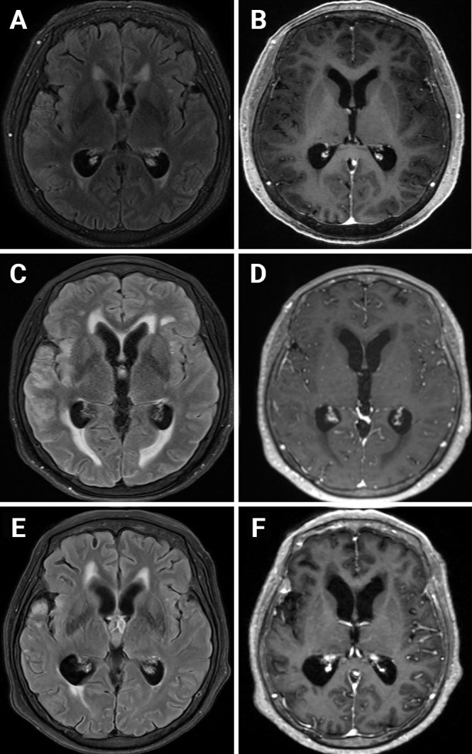 Autoimmune limbic encephalitis combined with leptomeningeal metastases of non-small cell lung cancer: treatment response to osimertinib, immunoglobulin, rituximab, and tocilizumab.