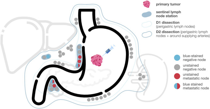 A combined approach for individualized lymphadenectomy in gastric cancer patients.